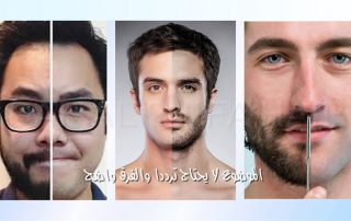 زراعة الشعر للرجال