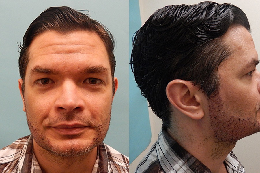 زراعة اللحية والشارب في تركيا