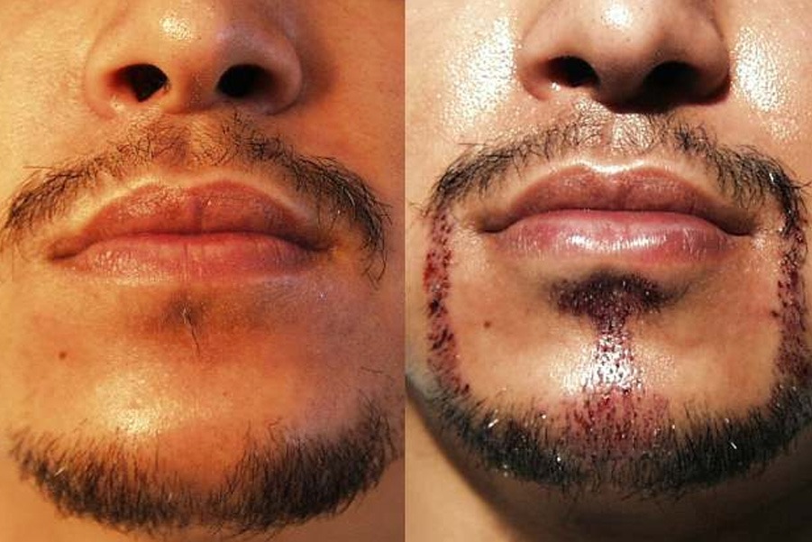 زراعة اللحية والشارب في تركيا