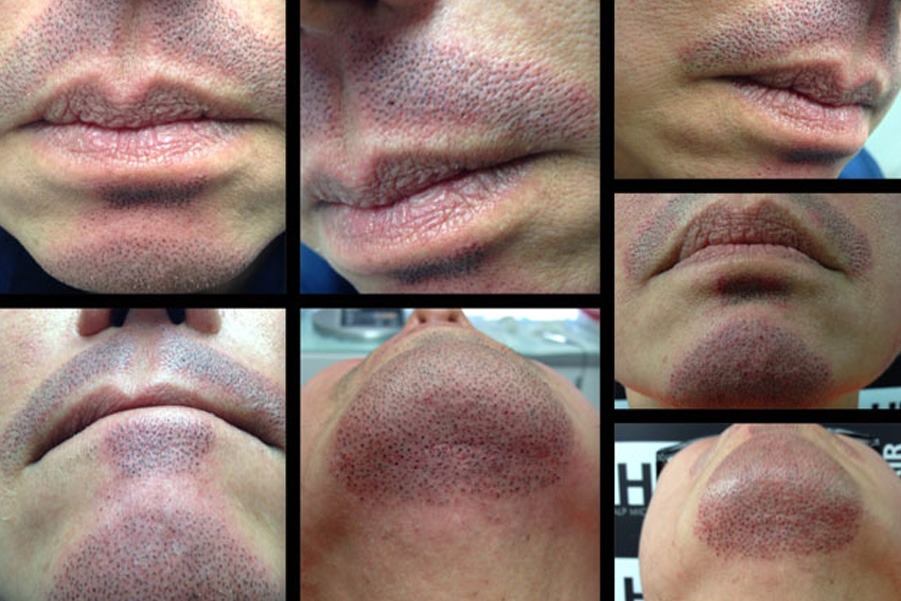 زراعة اللحية والشارب في تركيا