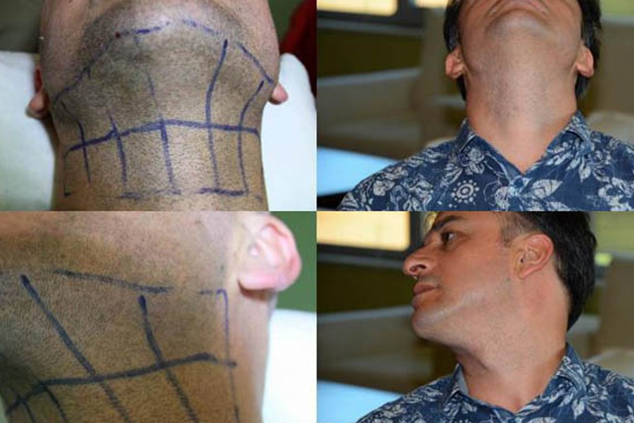 زراعة اللحية والشارب في تركيا