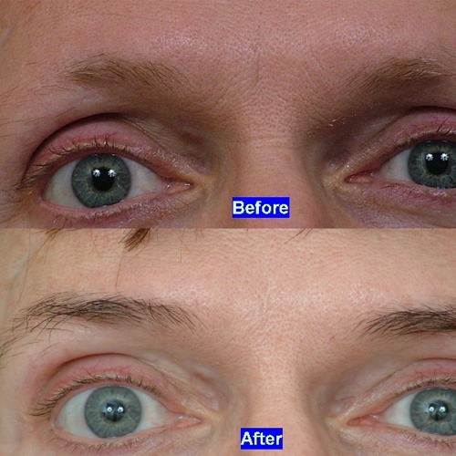 eyebrow-transplant